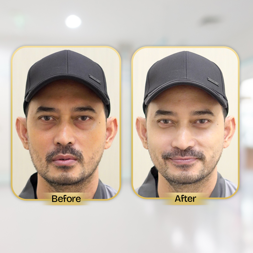 Before and After Treatment