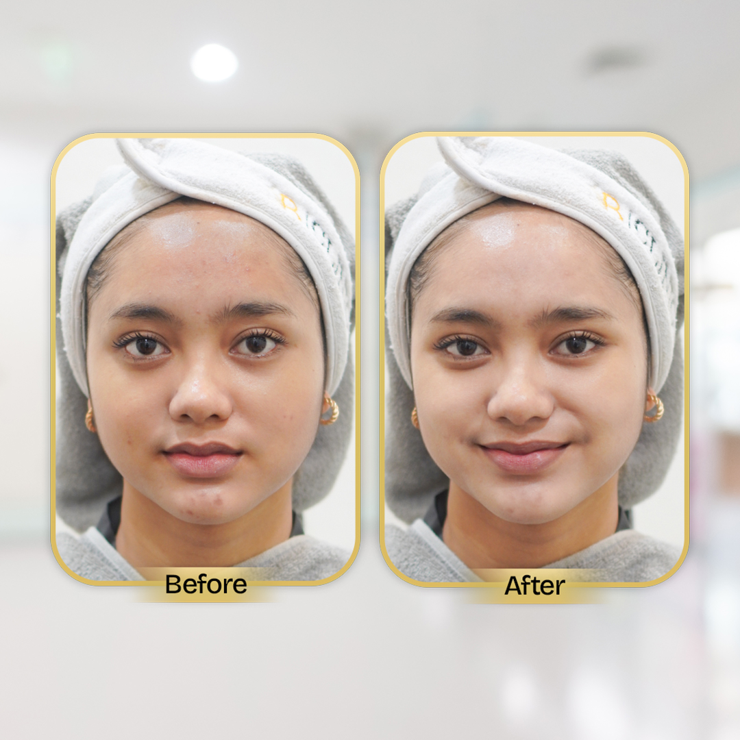 Before and After Treatment