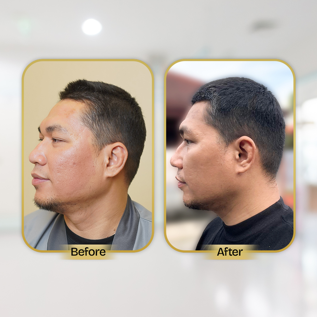 Before and After Treatment